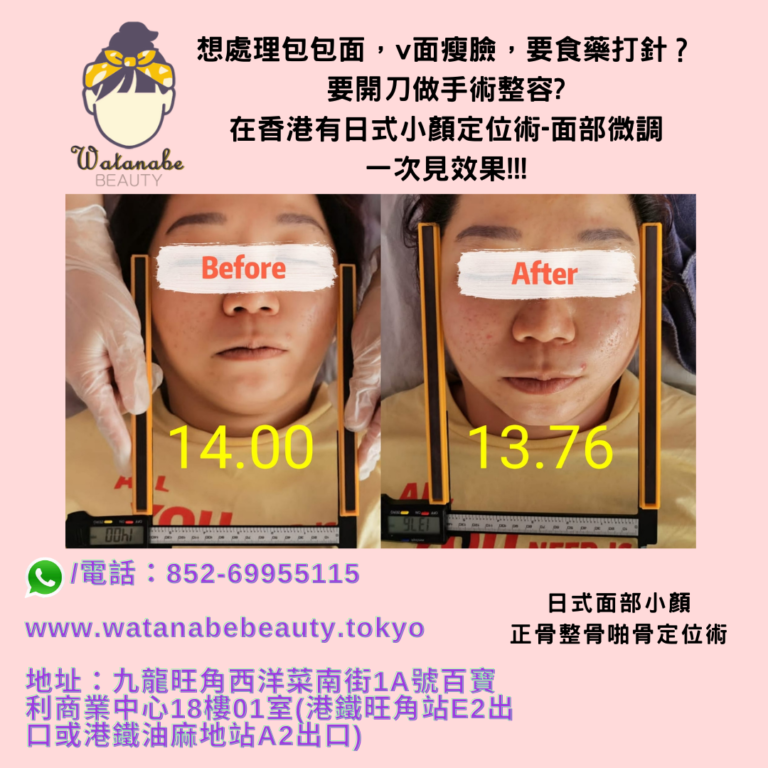 想處理包包面，v面瘦臉，要食藥打針要開刀做手術整容，在香港有日式小顏定位術面部微調，一次見效果！！！